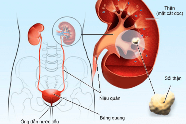 7 Nguyên Nhân Chính Gây Ra Sỏi Thận – Cảnh Báo Và Cách Phòng Ngừa Từ Gốc
