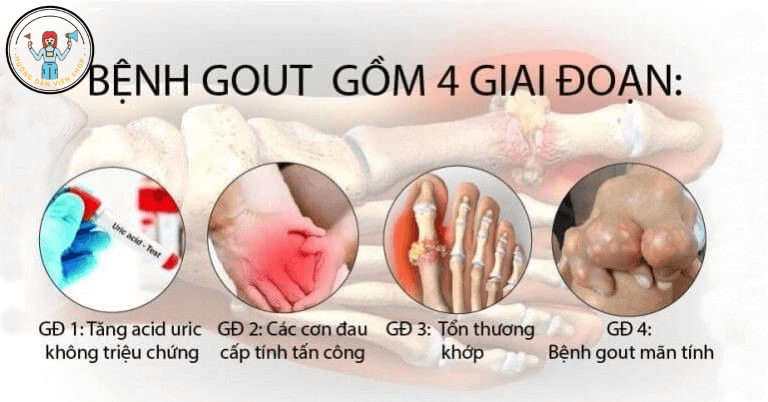 dieu-tri-benh-gout
